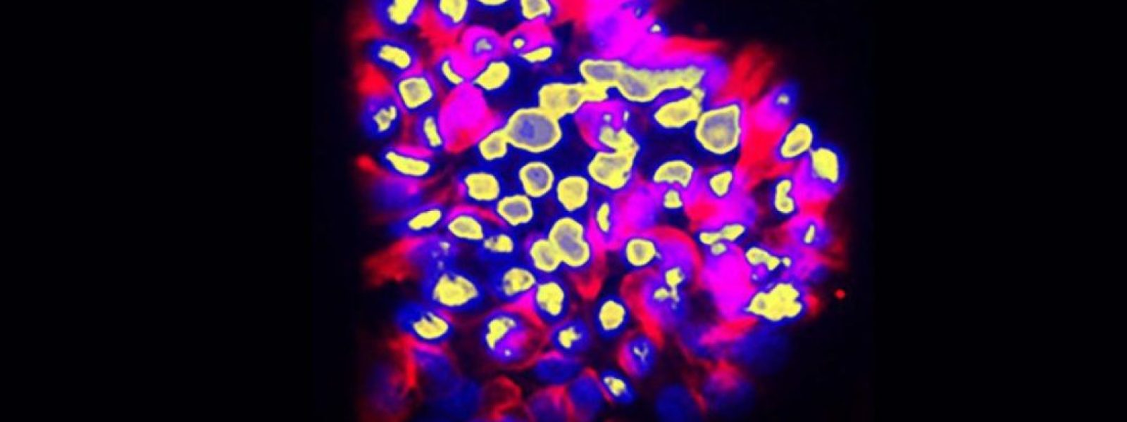 AI μοντέλο από το Πανεπιστήμιο της Γενεύης προβλέπει τις καρκινικές μεταστάσεις με ακρίβεια 80%