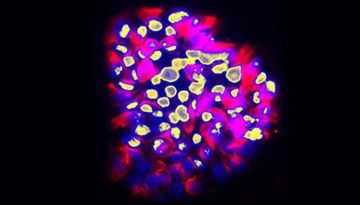 AI μοντέλο από το Πανεπιστήμιο της Γενεύης προβλέπει τις καρκινικές μεταστάσεις με ακρίβεια 80%