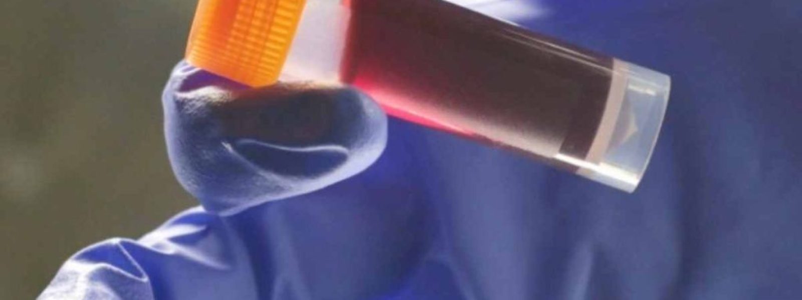 Μια ομάδα αίματος έχει μεγαλύτερο κίνδυνο για διαβήτη τύπου 2